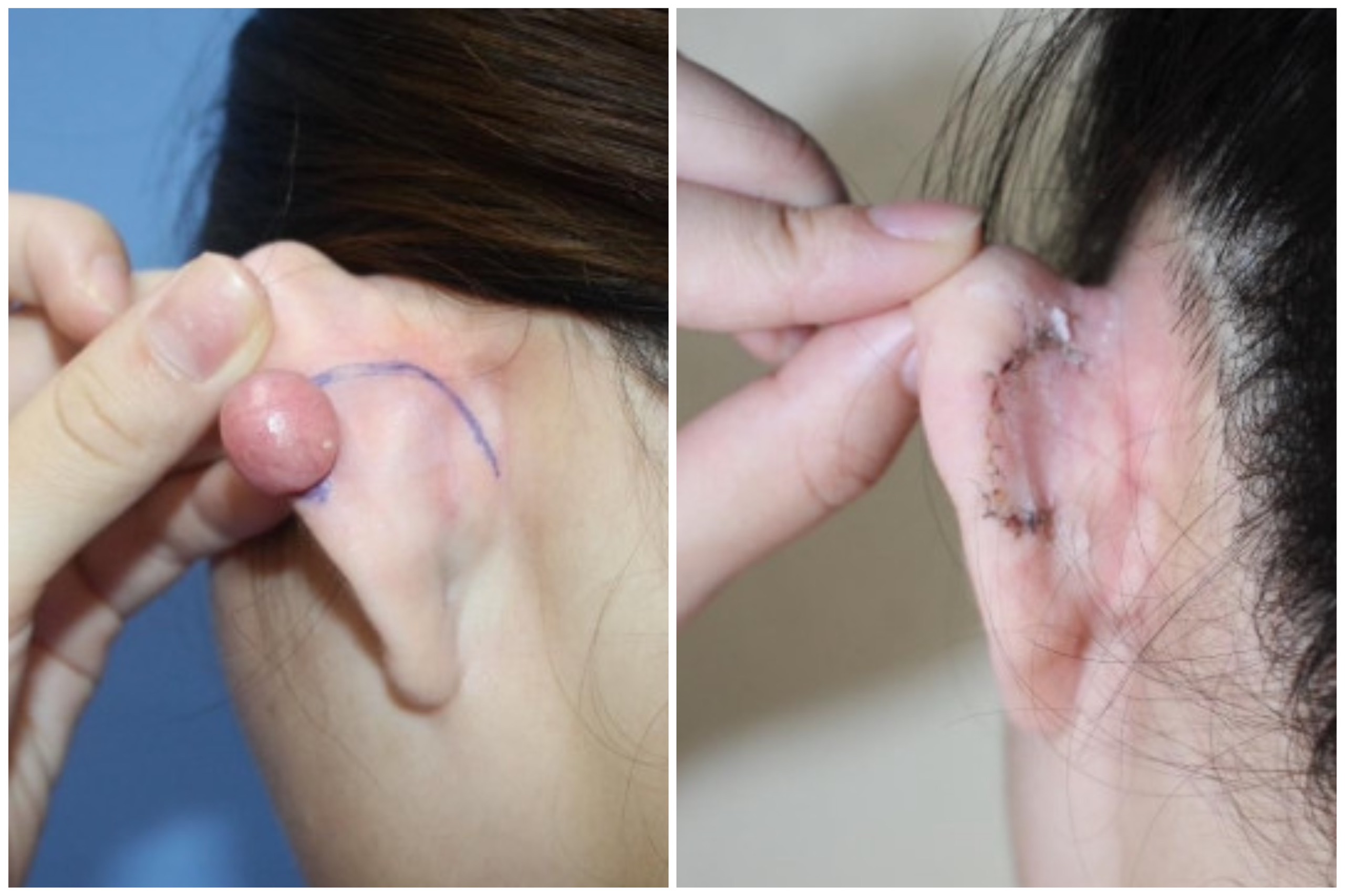 Phẫu thuật cắt bỏ được chỉ định cho sẹo lồi tai lớn, biến dạng. Đồ họa: BV