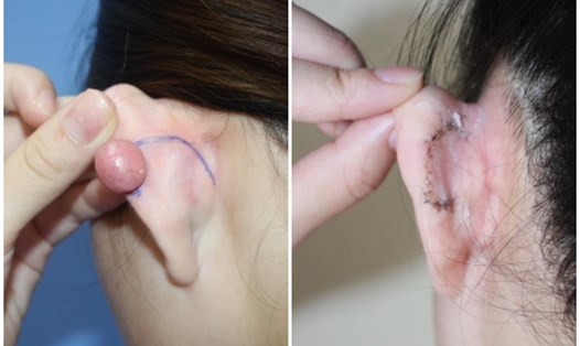 Phẫu thuật cắt bỏ được chỉ định cho sẹo lồi tai lớn, biến dạng. Đồ họa: BV