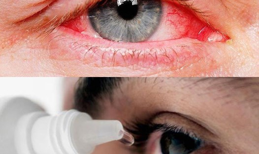 Biểu hiện của bệnh đau mắt đỏ. Đồ họa: Hương Giang