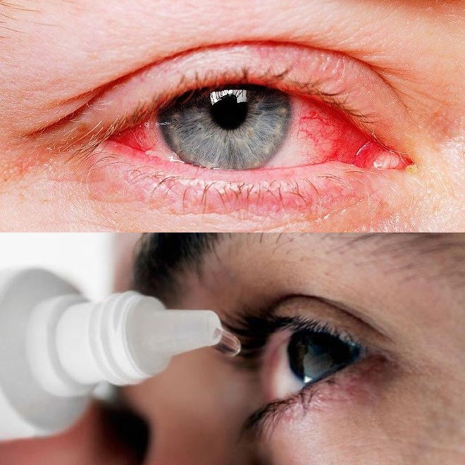 Đau mắt đỏ có thể biến chứng nguy hiểm, thậm chí mất thị lực