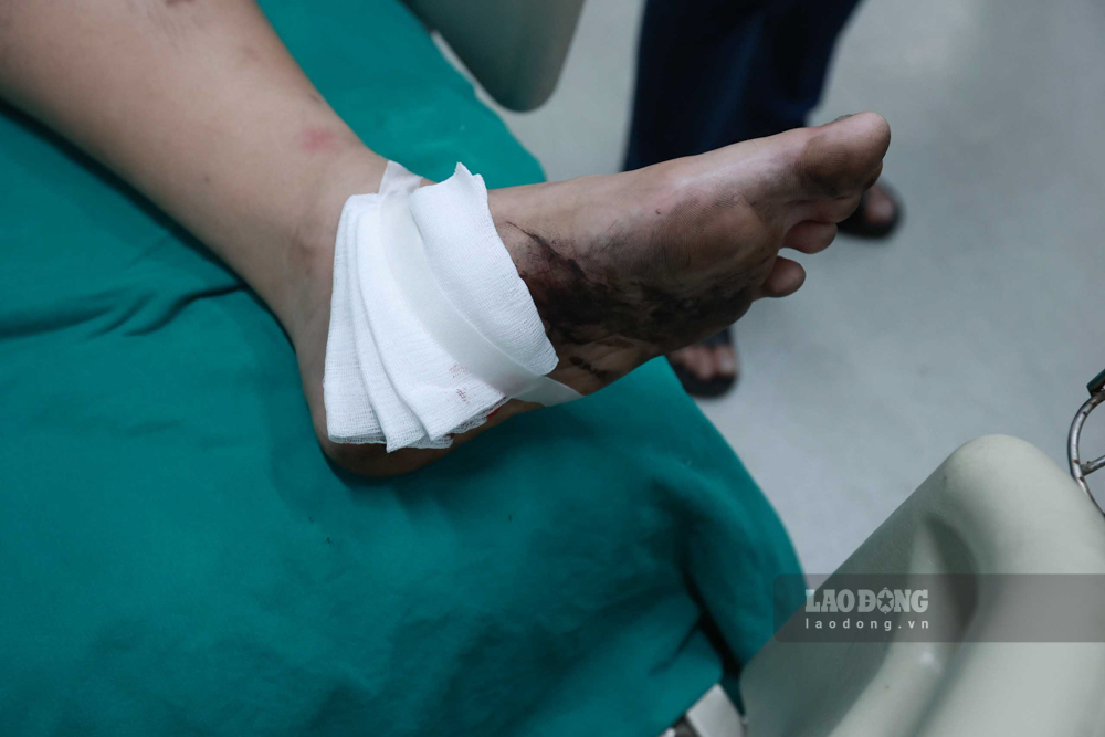 Một nạn nhân bị bỏng nặng phần bàn chân, đang được điều trị tại BV Bạch Mai.