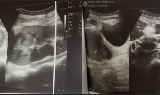 Hình ảnh siêu âm ruột thừa và thận của bệnh nhân trước và sau khi điều trị. Ảnh: BVCC