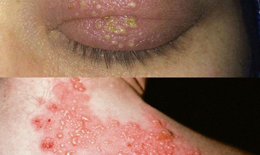 Biểu hiện của bệnh zona thần kinh. Đồ họa: Hương Giang