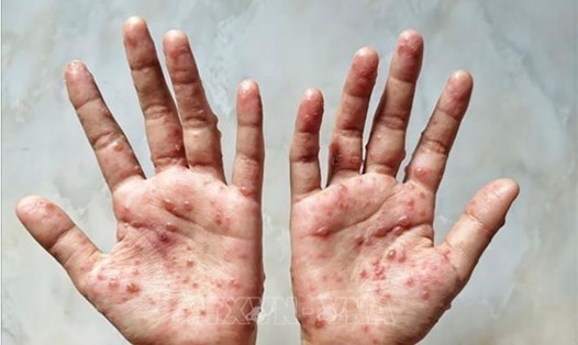 Bệnh đậu mùa khỉ (Mpox) khiến bệnh nhân sốt và nổi mụn. Ảnh: TTXVN