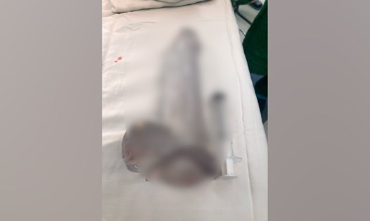 Dụng cụ tình dục được lấy ra sau tai nạn thủ dâm của một nam bệnh nhân. Ảnh: BSCC