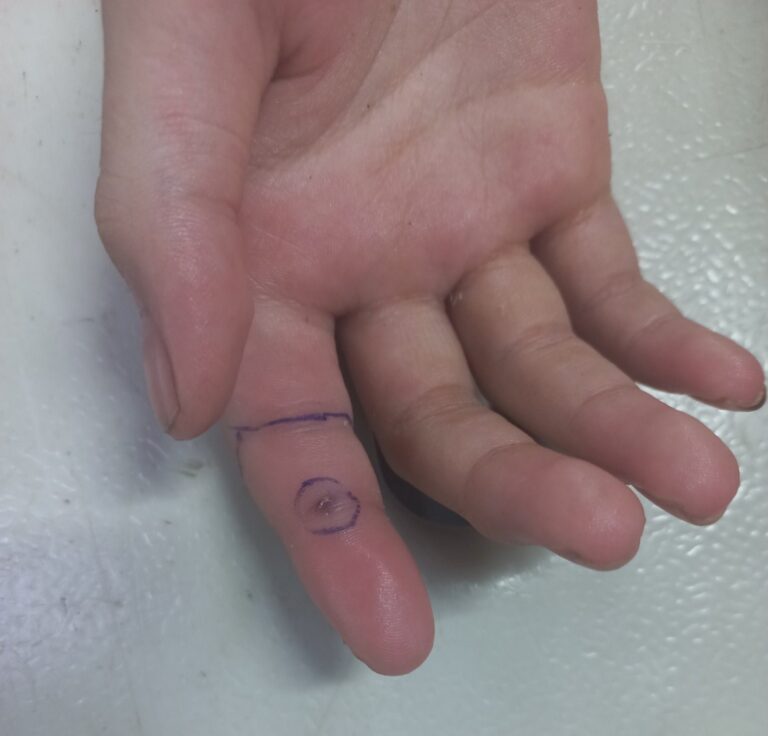 Vết rắn cắn trên tay 1 trong 2 bé gái song sinh ở Phú Thọ. Ảnh: BVCC