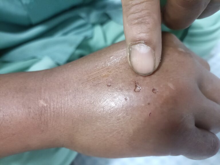 Vết rắn cắn trên tay bệnh nhân ở Ba Vì, Hà Nội. Ảnh: BVCC