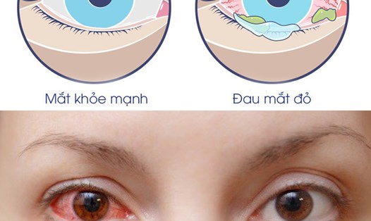 Dịch bệnh đau mắt đỏ ngày càng gia tăng hiện nay. Đồ họa: Hương Giang
