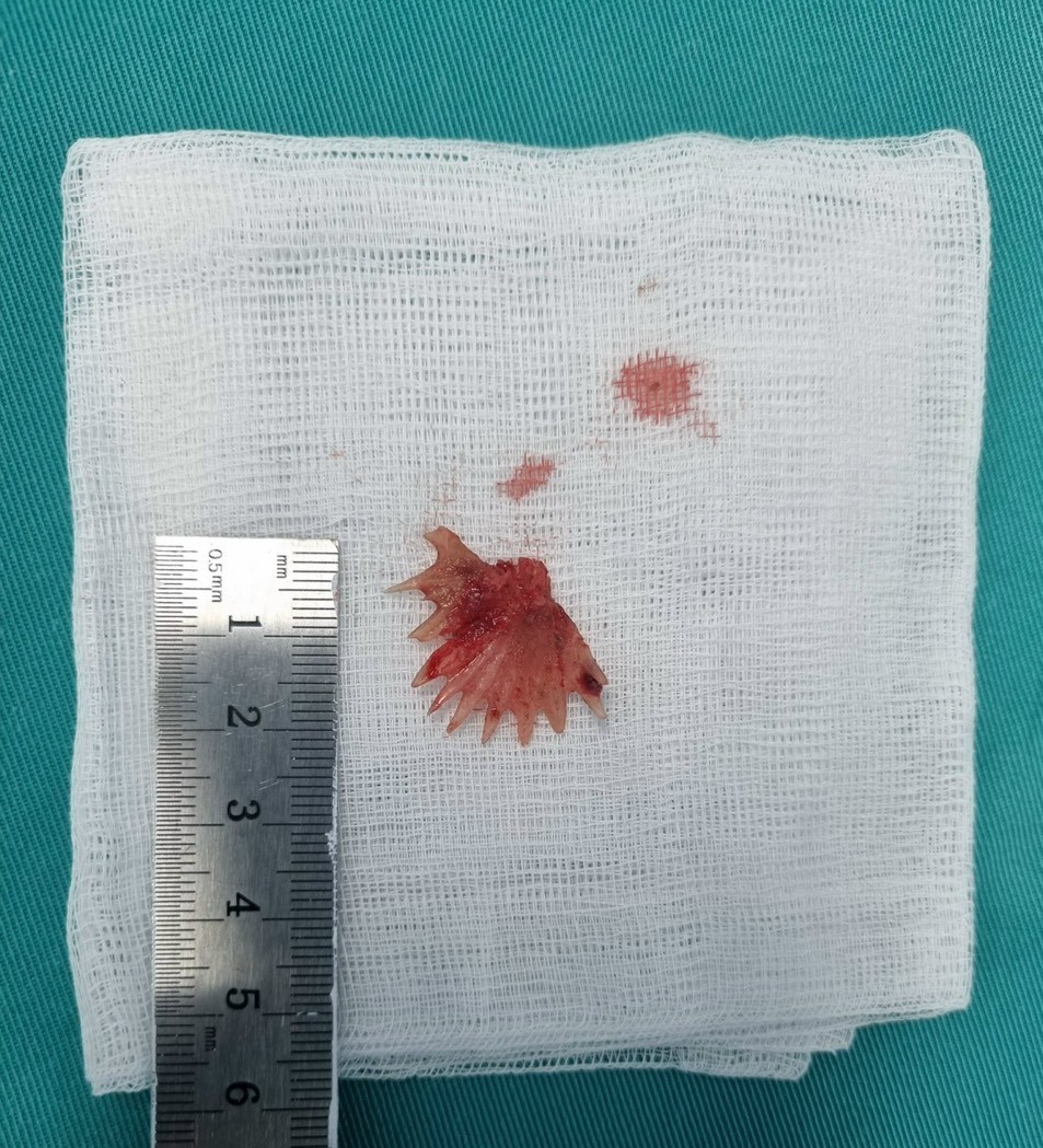 Dị vật xương cá được các bác sĩ lấy ra. Ảnh: BVCC