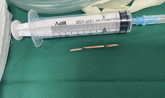 Hình ảnh dị vật đâm thủng dạ dày của bệnh nhân H. Ảnh: Bệnh viện cung cấp

