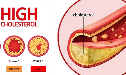 Tăng cholesterol khiến cơ thể mệt mỏi. Ảnh: Nguyễn Ly 