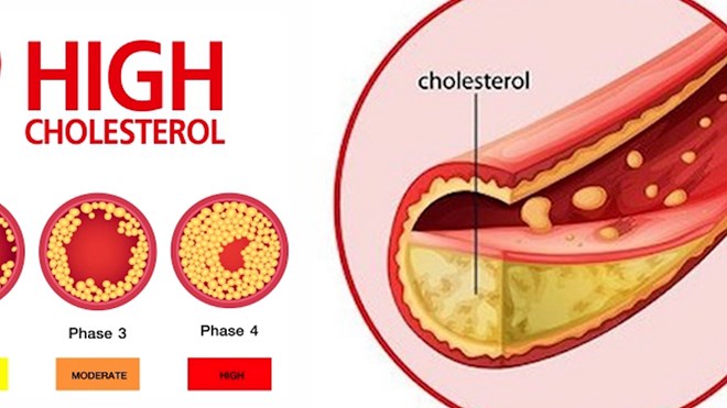 6 dấu hiệu của cơ thể báo động cholesterol máu cao