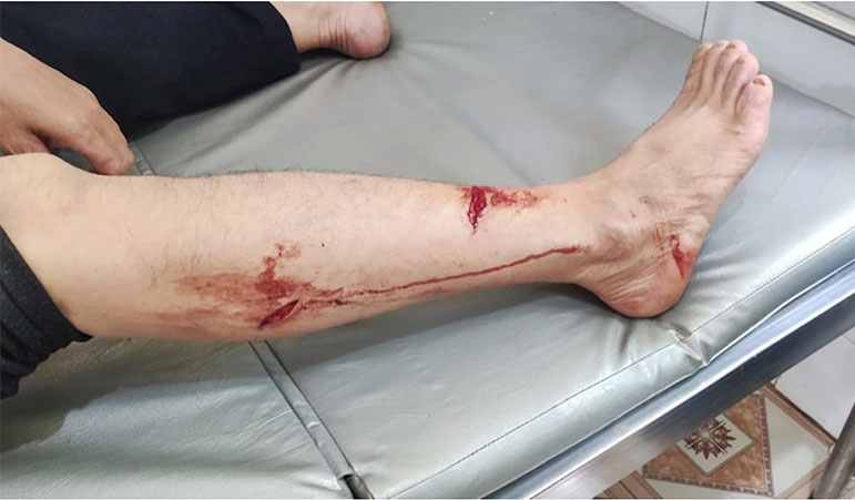 Vào khoảng tháng 7.2023, một người dân đã bị cá thể Voọc đen má tấn công phải khâu 6 mũi. Ảnh: Đơn vị cung cấp.
