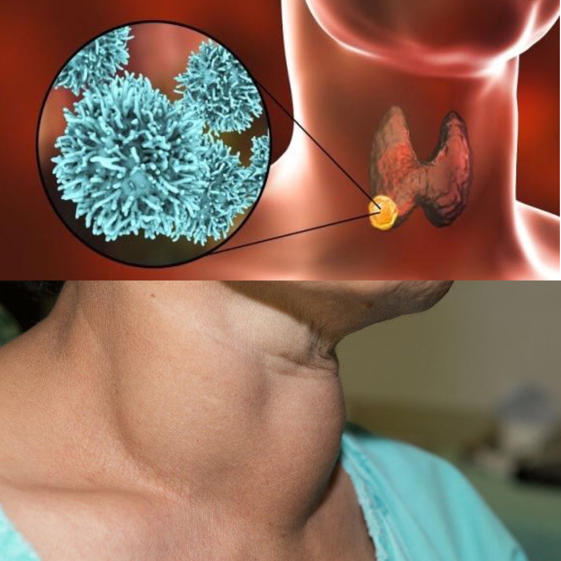 Dấu hiệu của bệnh ung thư tuyến giáp. Đồ họa: Hương Giang