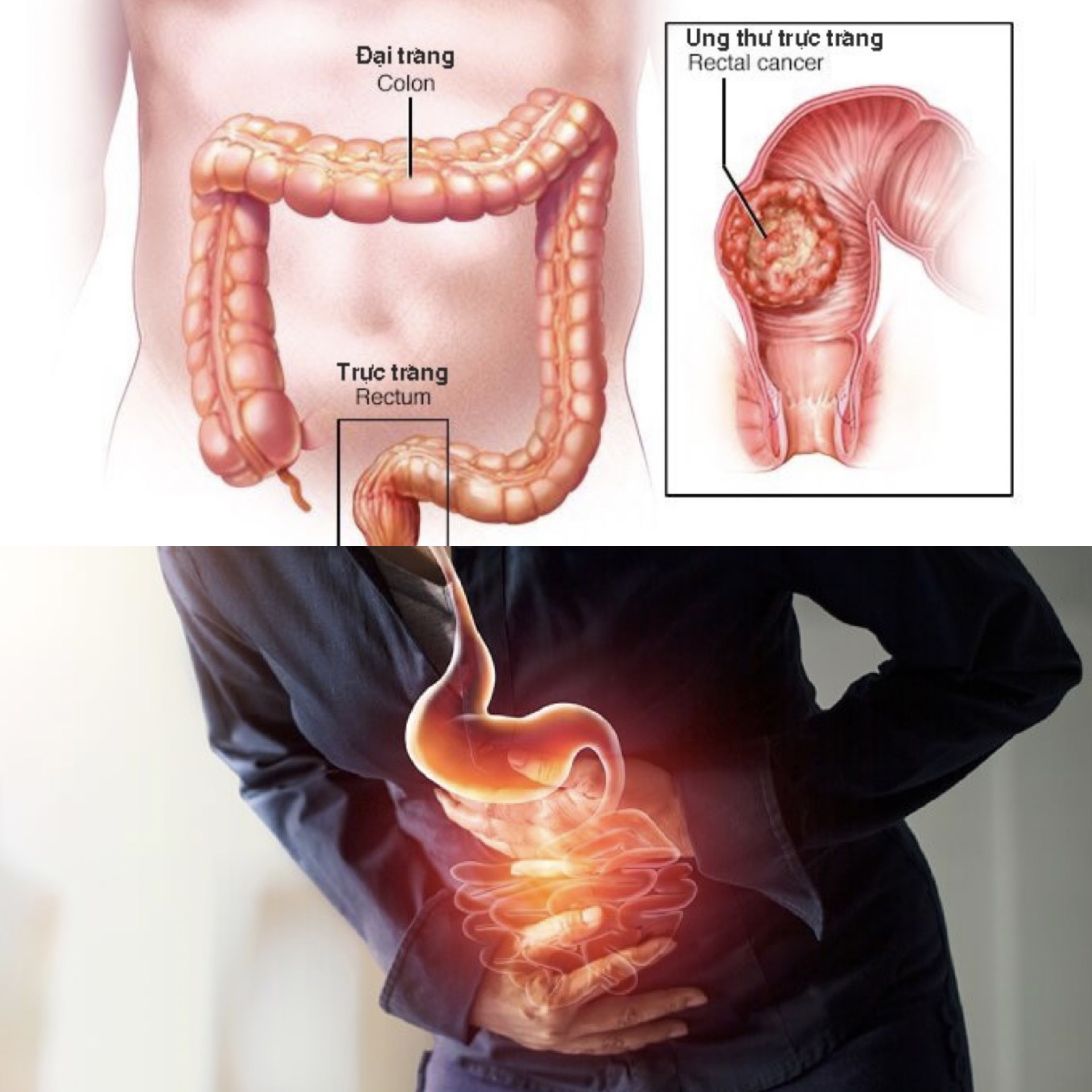Dấu hiệu của bệnh ung thư đại trực tràng. Đồ họa: Hương Giang