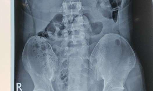 Chụp X-Quang, các bác sĩ phát hiện dị vật đã chui sâu vào trong trực tràng. Ảnh: BVCC