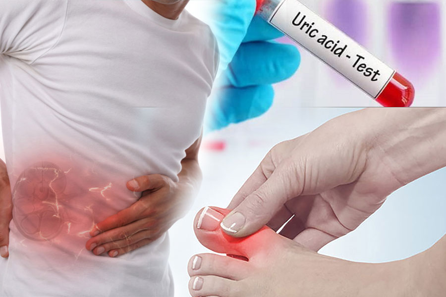 Nồng độ axit uric trong cơ thể tăng lên là một bệnh chuyển hóa mãn tính do rối loạn chuyển hóa purine. Nó có thể ảnh hưởng đến sức khỏe của thận, làm tăng nguy cơ tạo sỏi và các trường hợp nghiêm trọng khác. Đồ họa: Ngọc Thùy