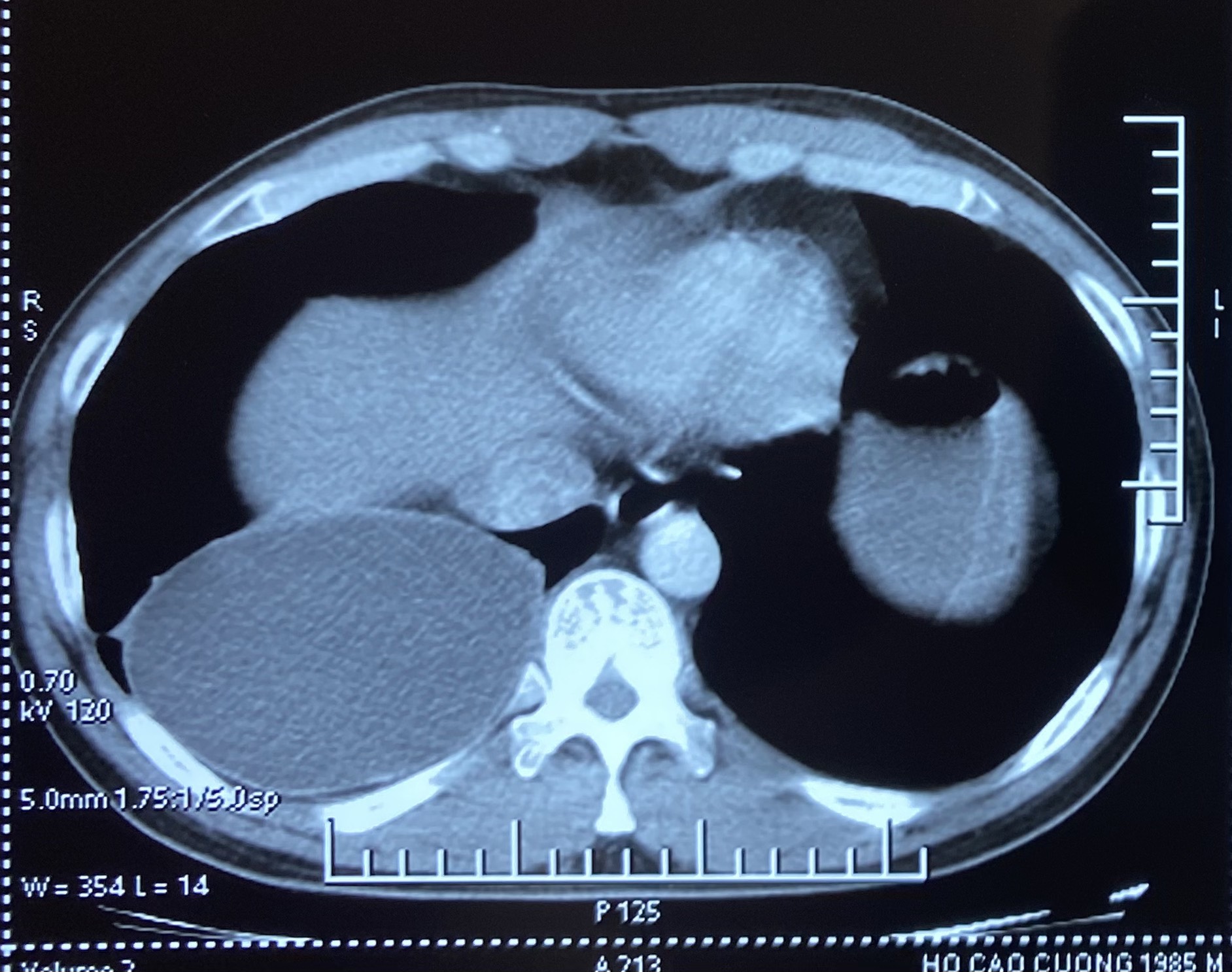 Tổn thương trên phim cắt lớp vi tính lồng ngực. Ảnh: BVCC