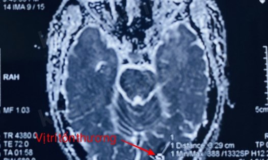 Hình ảnh tổn thương não của người bệnh V.V.L. Ảnh: Bệnh viện Hữu nghị Việt Tiệp