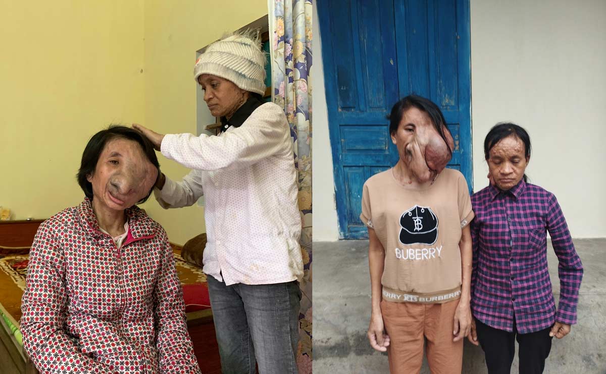 Hai chị em ruột ở Thái Bình bị căn bệnh quái ác, khuôn mặt bị biến dạng. Ảnh: Hội Liên hiệp Phụ nữ xã Trọng Quan cung cấp