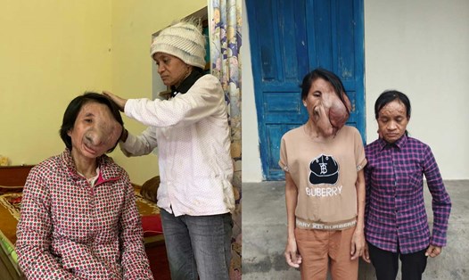 Hai chị em ruột ở Thái Bình bị căn bệnh quái ác, khuôn mặt bị biến dạng. Ảnh: Hội Liên hiệp Phụ nữ xã Trọng Quan cung cấp