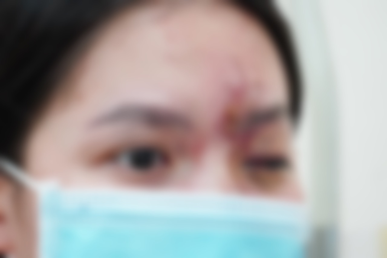 Nữ bệnh nhân 17 tuổi bị mất thị lực mắt trái sau tiêm filler. Ảnh: BVCC