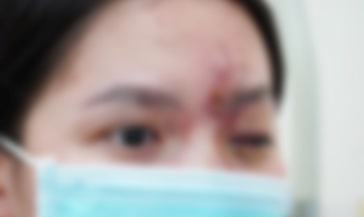 Nữ bệnh nhân 17 tuổi bị mất thị lực mắt trái sau tiêm filler. Ảnh: BVCC