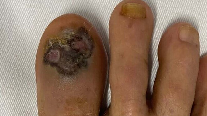 Ngón chân đen đầu chữa 2 năm không ra bệnh, hoá mắc ung thư