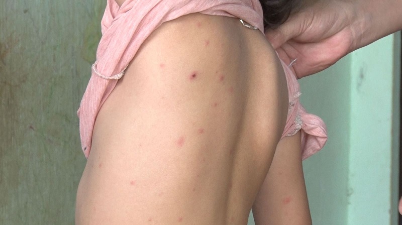 Các nốt mụn nước do bệnh thuỷ đậu gây nên. Ảnh: Quang Nhật