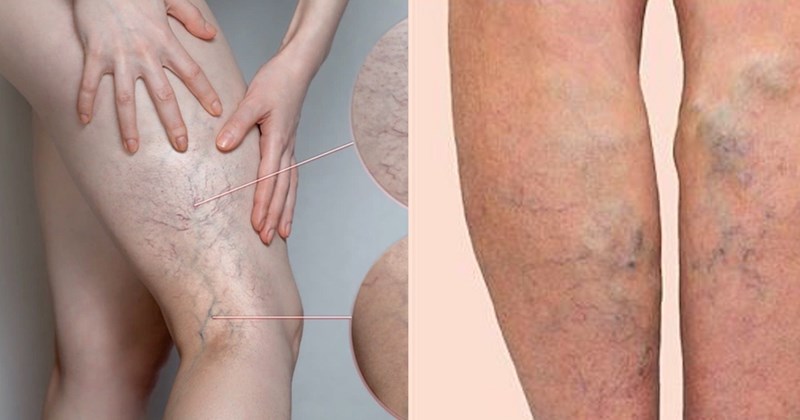 Suy giãn tĩnh mạch - nên làm gì để hạn chế bị nặng hơn