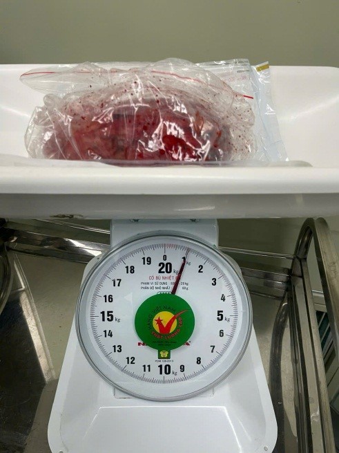 The tumor weighing more than 1kg was successfully removed. Photo: Dieu Hien