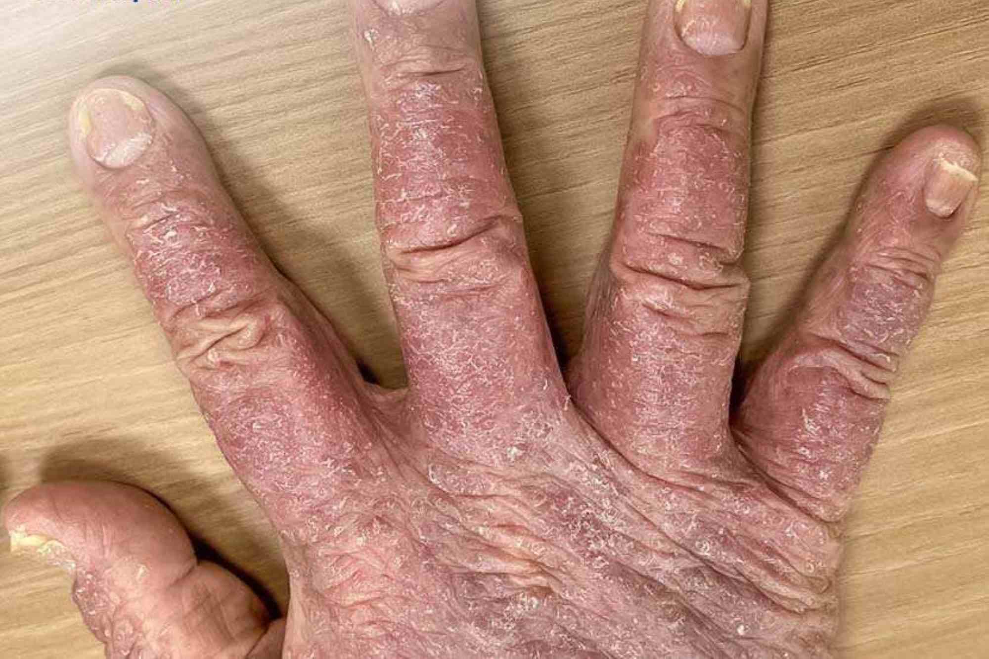 Bàn tay của một bệnh nhân vảy nến. Ảnh: Bệnh viện cung cấp