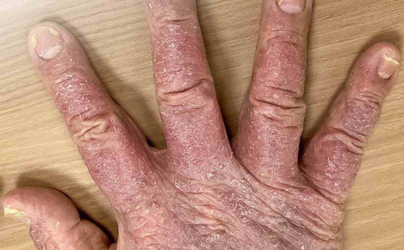 The hand of a psoriasis patient. Photo: Provided by the hospital