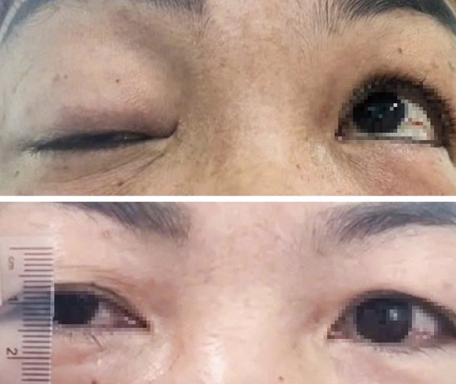 Mắt bệnh nhân được cải thiện rõ rệt sau điều trị. Ảnh: BSCC