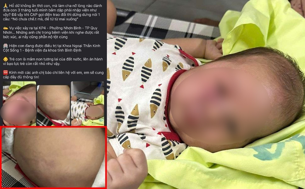 Thông tin và hình ảnh cháu bé 3 tháng tuổi ở Bình Định bị cha đánh đập đến mức phải nhập viện cấp cứu được lan truyền trên mạng xã hội. Ảnh chụp màn hình