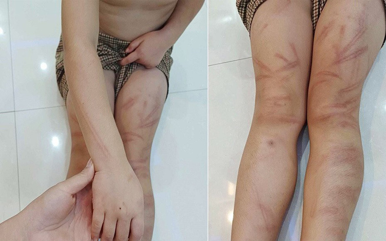 Nhiều học sinh mầm non ở huyện Nghĩa Đàn (Nghệ An) bị lớp trưởng đánh đến bầm tím. Ảnh: Hải Đăng