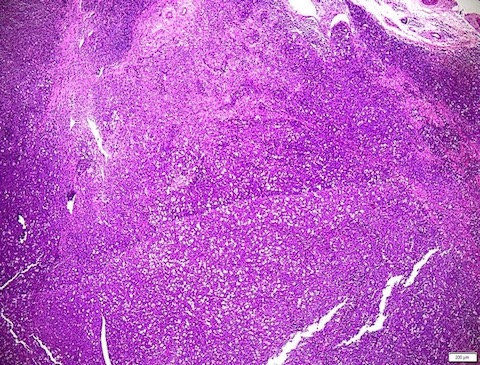Histopathological image shows diffuse structural tumor tissue. Photo: BVCC