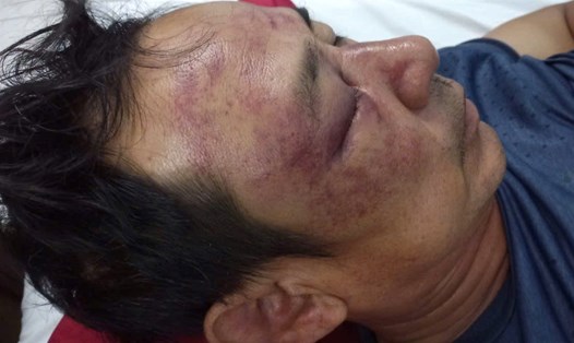 Hiện ông Lư đang nhập viện tại Bệnh viện Trung ương Huế. Ảnh: Văn Luýt