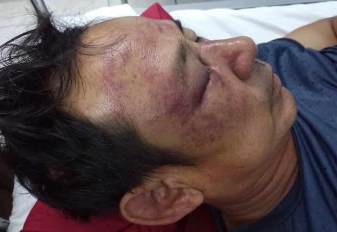 Mr. Lu was beaten and hospitalized, and is being treated at Hue Central Hospital. Photo: Van Luyt