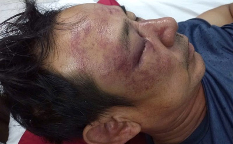 Mr. Lu was beaten and hospitalized, and is being treated at Hue Central Hospital. Photo: Van Luyt