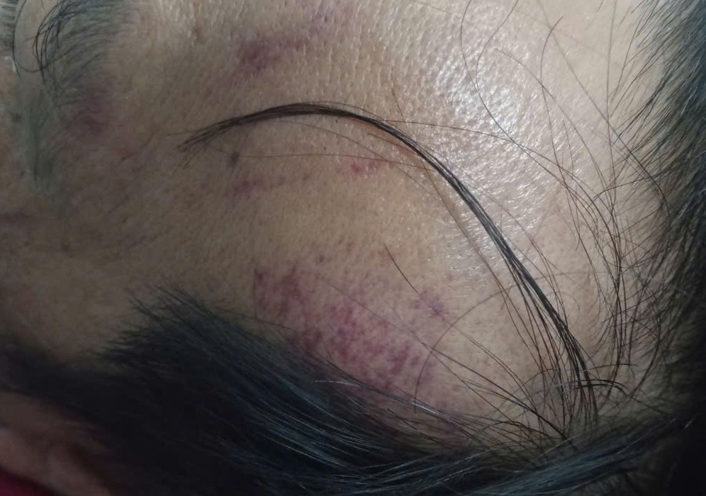 Ông Lư bị chấn thương đang nằm ở Bệnh viện Trung ương Huế. Ảnh: Văn Luýt