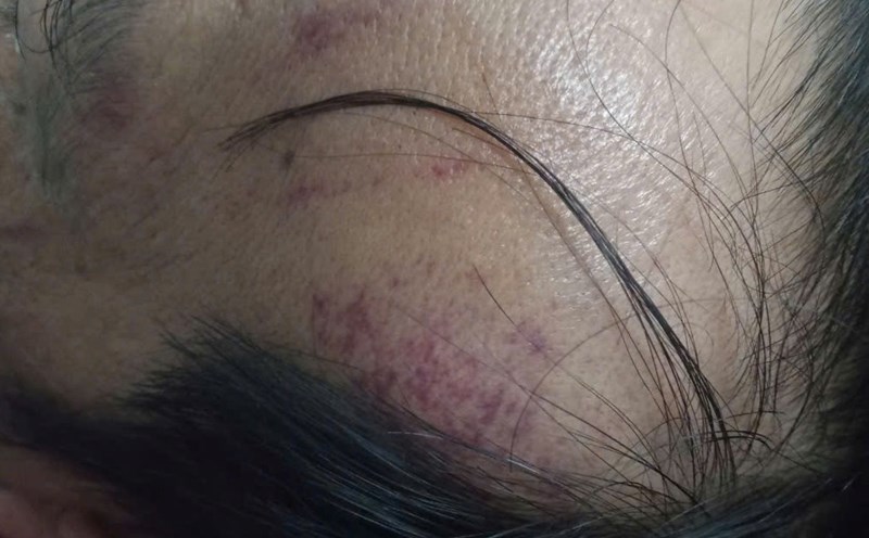 Ông Lư bị chấn thương đang nằm ở Bệnh viện Trung ương Huế. Ảnh: Văn Luýt
