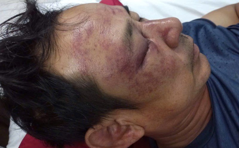 Hiện ông Lư đang nhập viện tại Bệnh viện Trung ương Huế. Ảnh: Văn Luýt