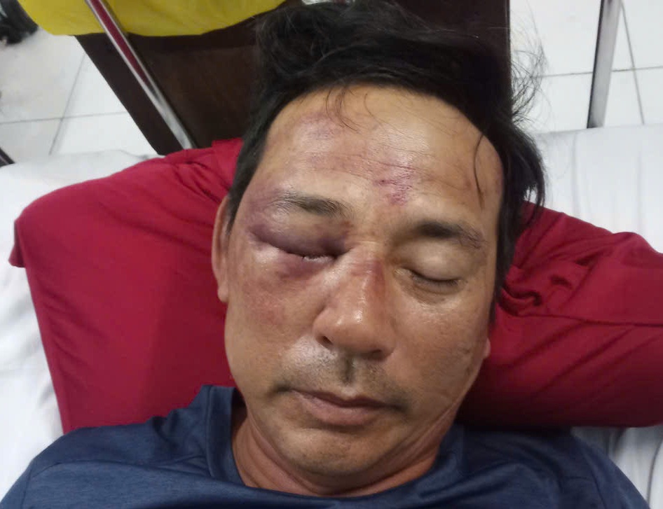 Mr. Ngo Van Lu was beaten and had to be admitted to Hue Central Hospital for treatment. Photo: Van Luyt