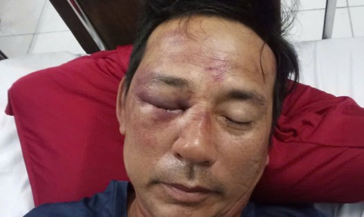 Ông Ngô Văn Lư bị đánh phải nhập viện Trung ương Huế để điều trị. Ảnh: Văn Luýt