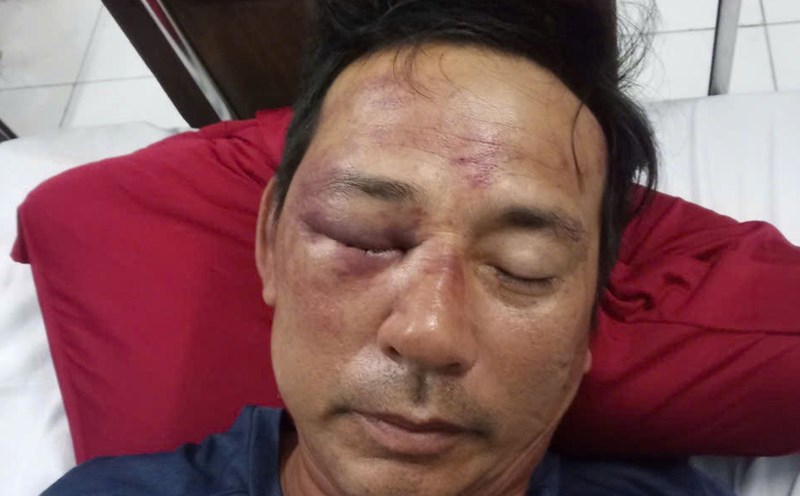 Mr. Ngo Van Lu was beaten and had to be admitted to Hue Central Hospital for treatment. Photo: Van Luyt