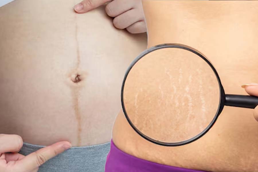 Skin problems in women during pregnancy. Graphics: Thien Nhan