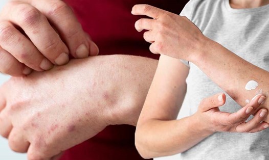Nguyên nhân phổ biến gây phát ban trên da. Đồ hoạ: Thiện Nhân