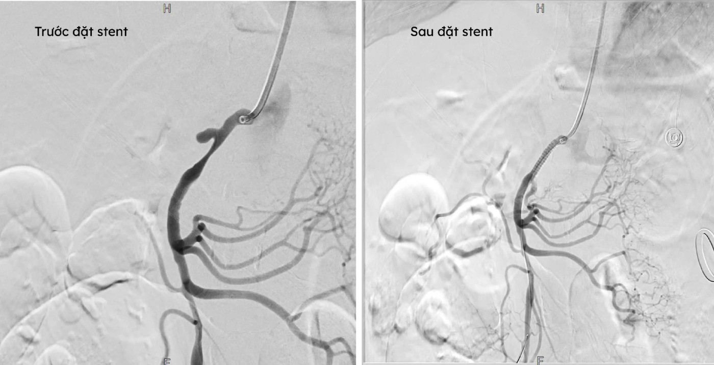 Hình ảnh DSA trước và sau can thiệp đặt stent. BVCC