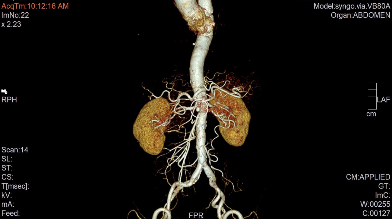 Hình chụp CT SCAN vị trí bóc tách phình động mạch mạc treo tràng trên. Ảnh: BVCC